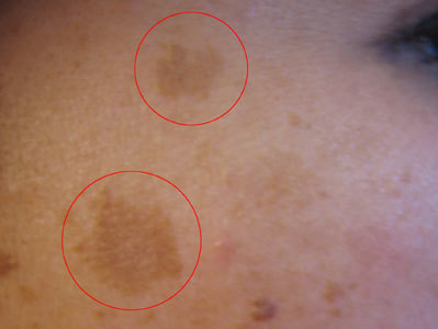 Dr. Yeung Ho Hong(楊浩康) explains Melasma(賀爾蒙斑)