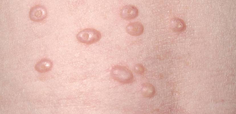 Dr. Yeung Ho Hong(楊浩康) explains Molluscum Contagiosum(傳染性軟疣)