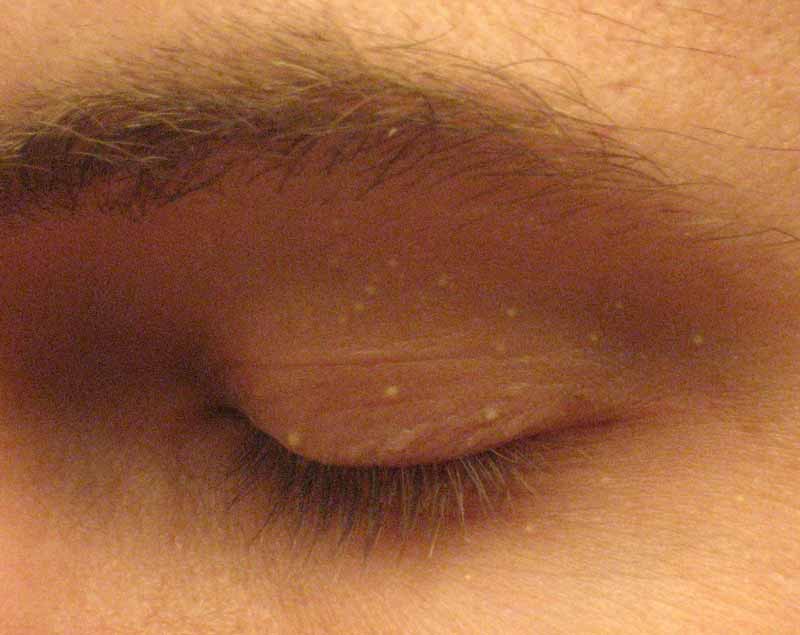 Dr. Yeung Ho Hong(楊浩康) explains milia(粟粒疹是甚麼)